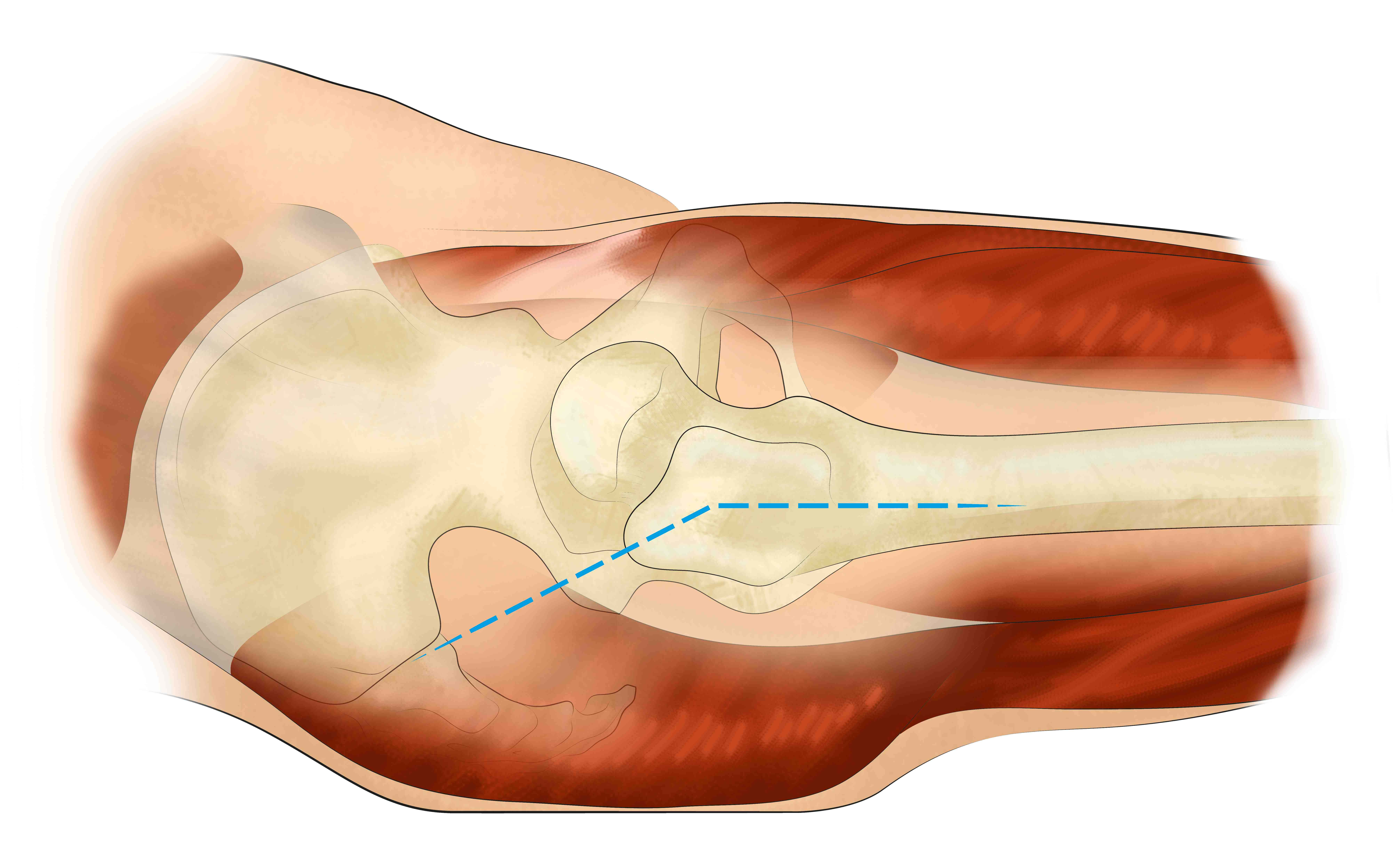 prothese totale de hanche mini abord voie antérieure anatomie hanche Dr Bohu 